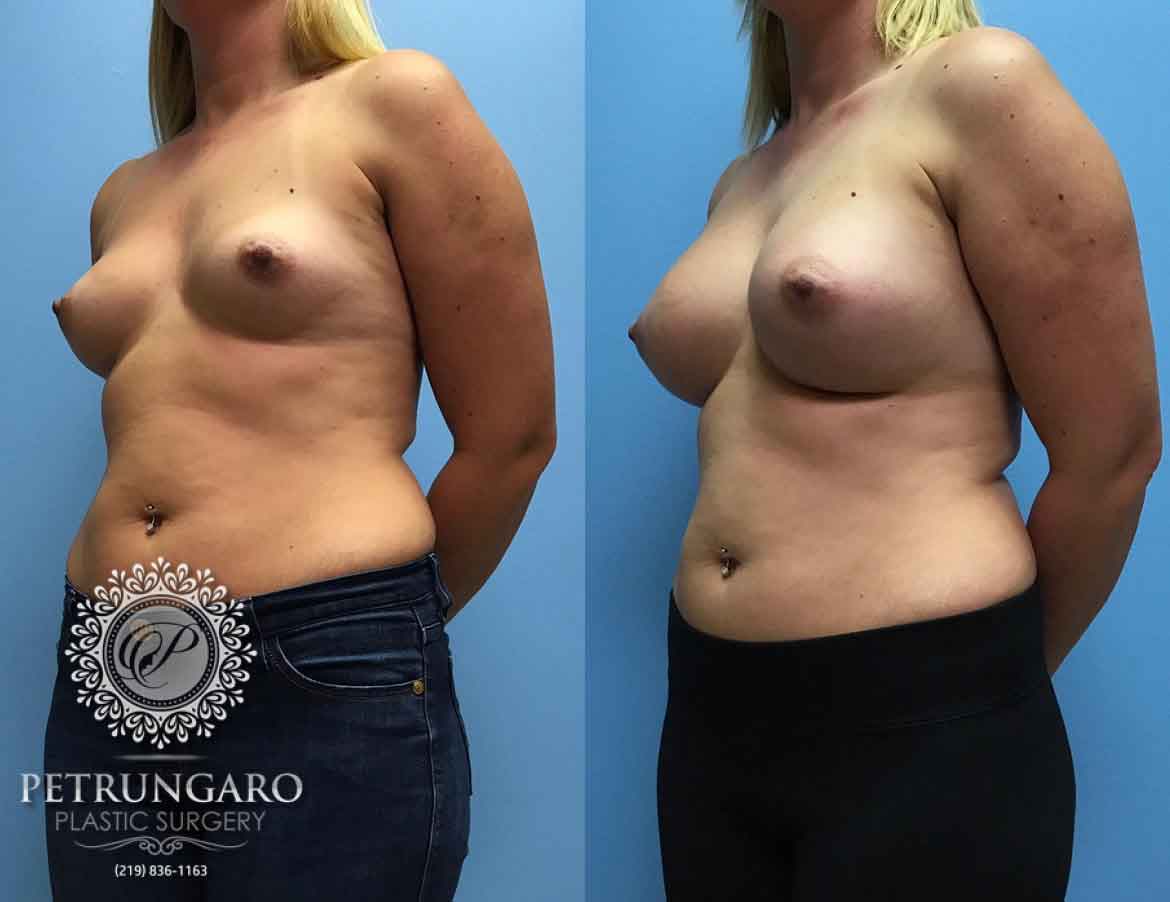 36-woman-3-months-after-breast-augmentation-1