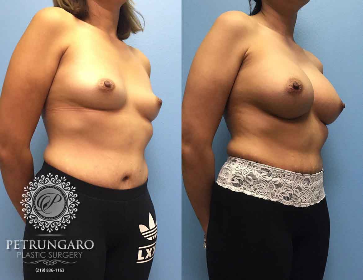 36-woman-3-months-after-breast-augmentation-1b