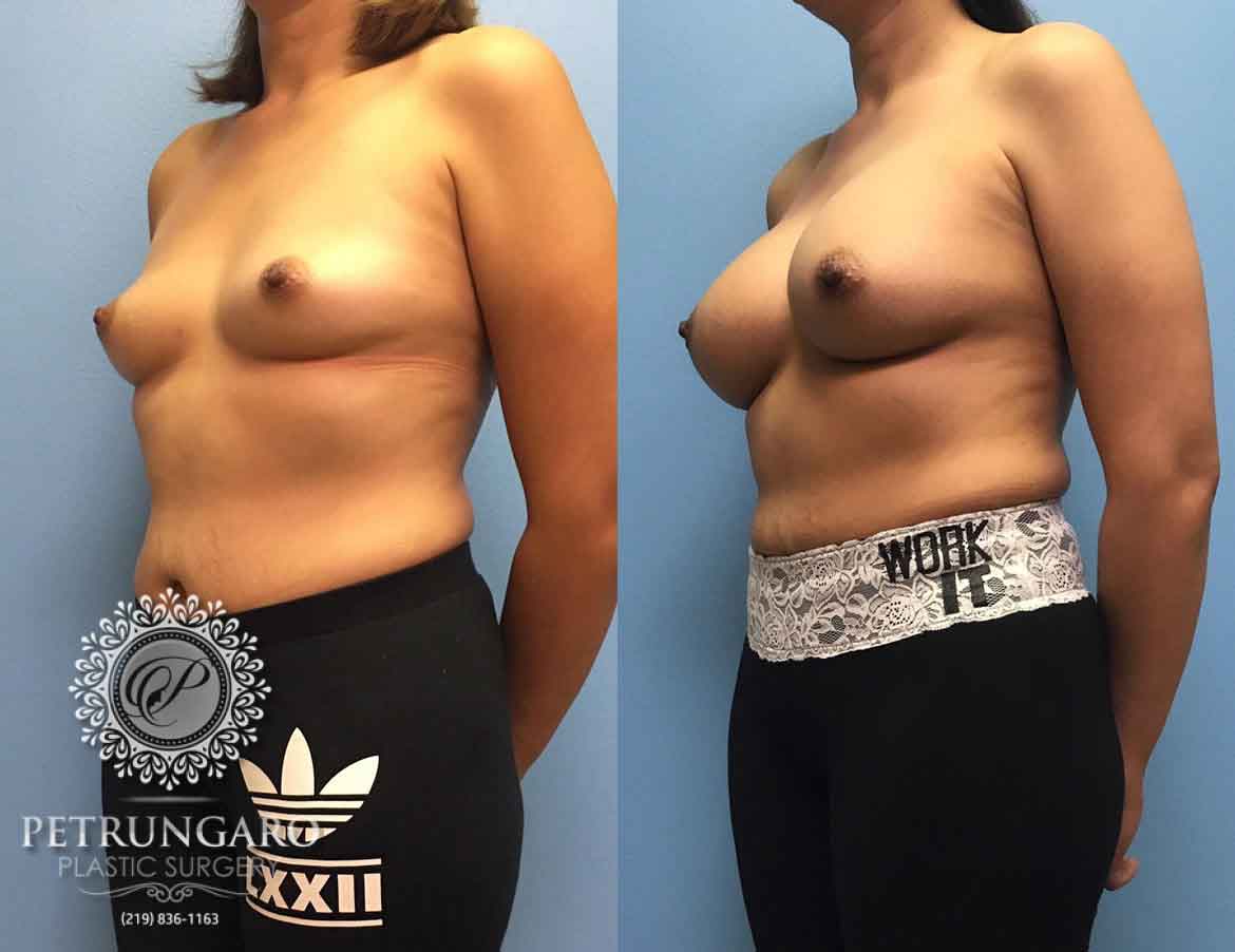 36-woman-3-months-after-breast-augmentation-2b
