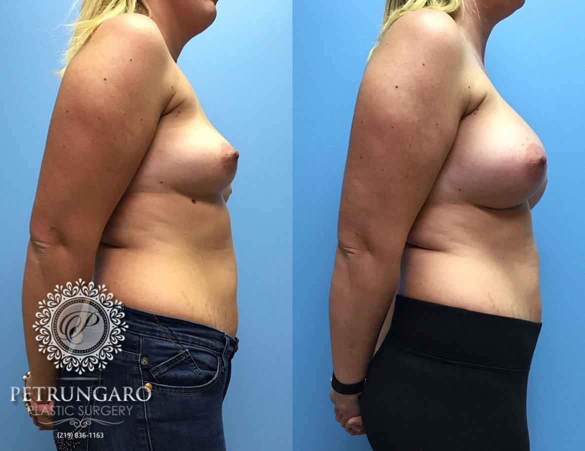 36-woman-3-months-after-breast-augmentation-3