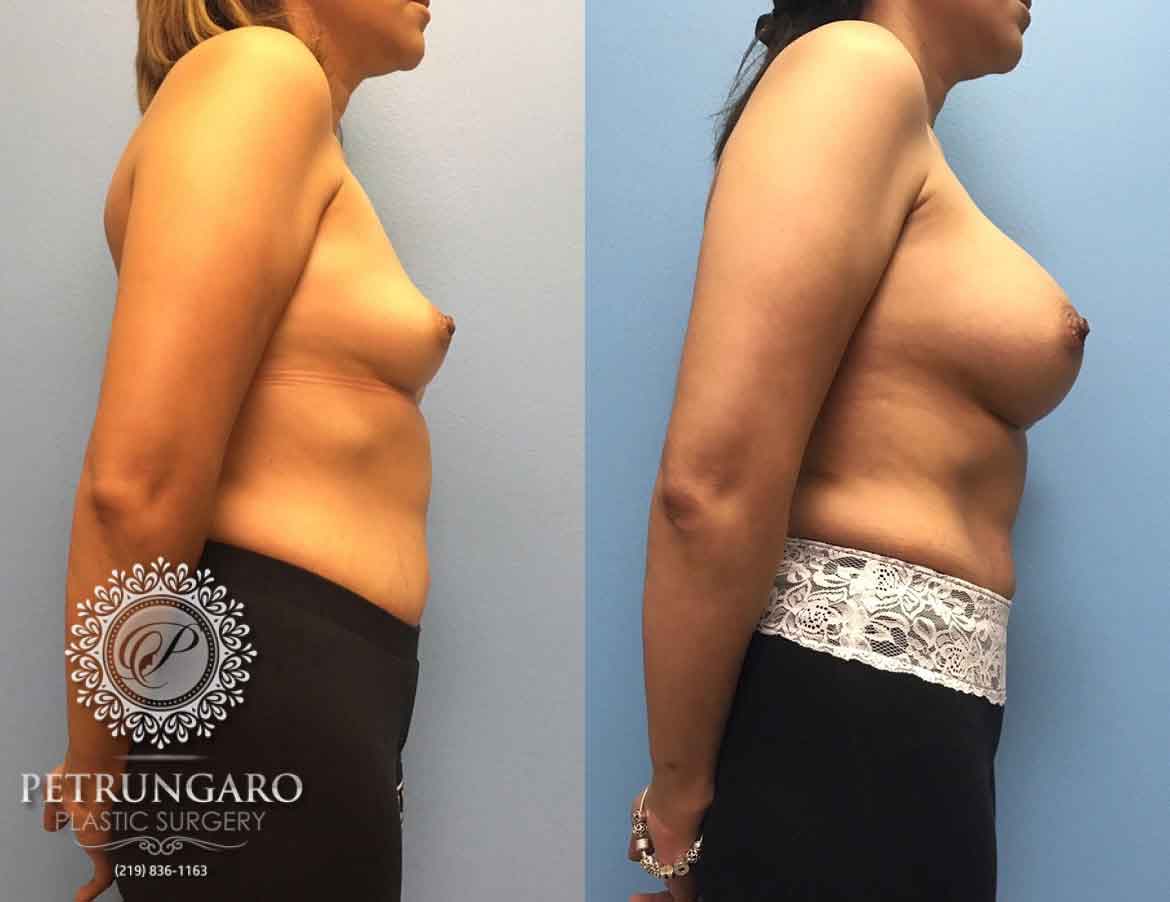 36-woman-3-months-after-breast-augmentation-3b