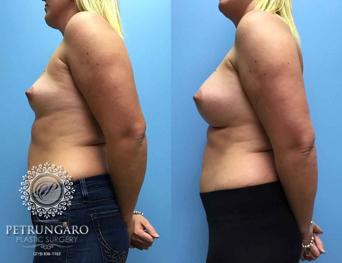 36-woman-3-months-after-breast-augmentation-4