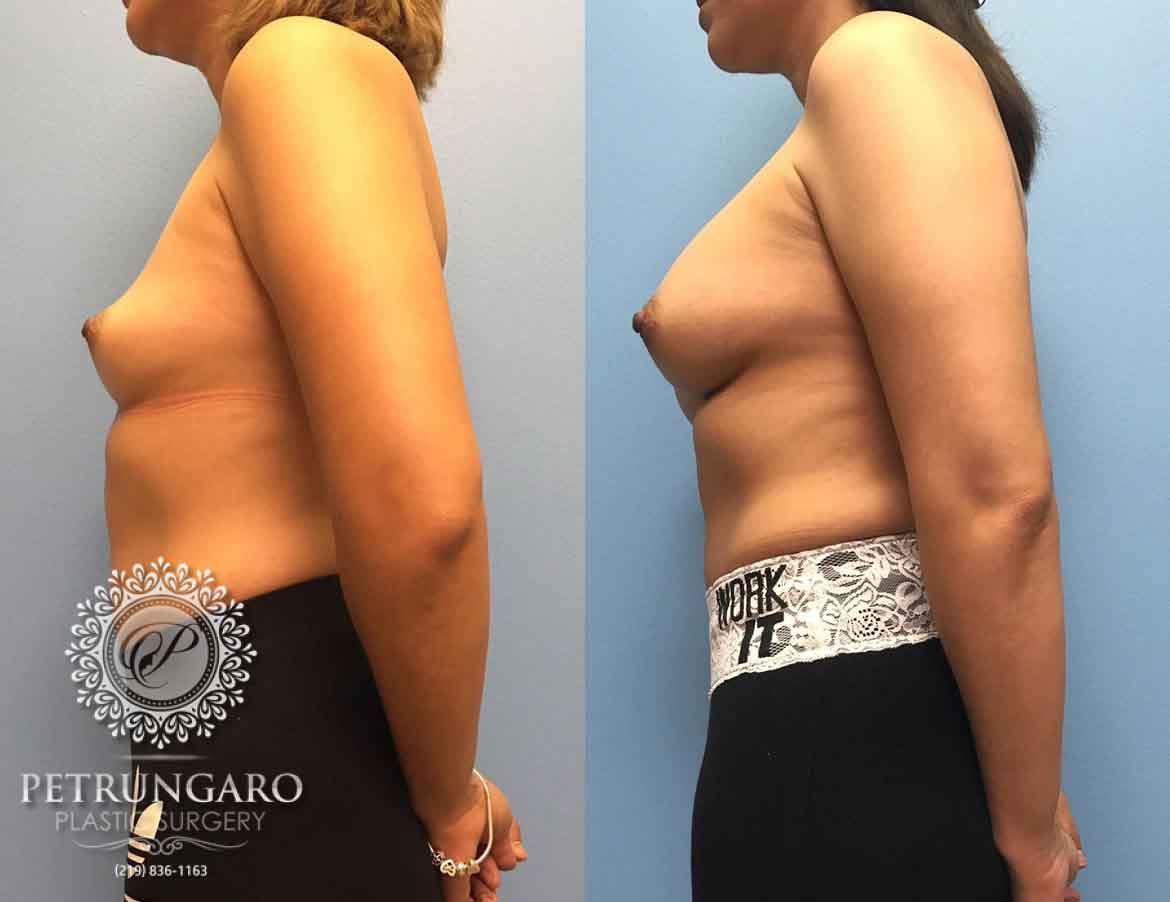 36-woman-3-months-after-breast-augmentation-4b
