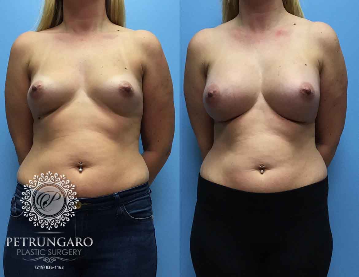 36-woman-3-months-after-breast-augmentation-5