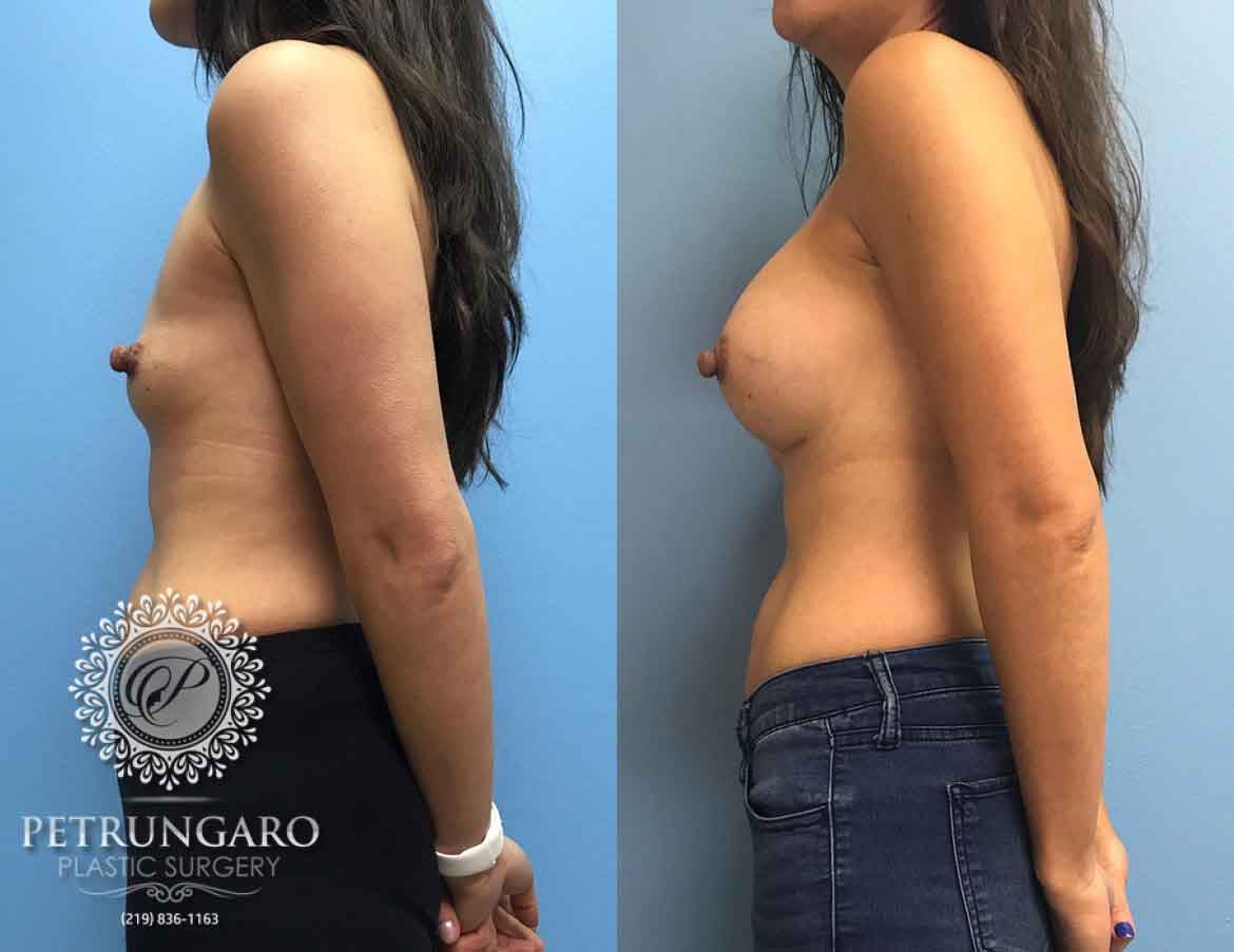 37-breast-augmentation-implants-chicago-2