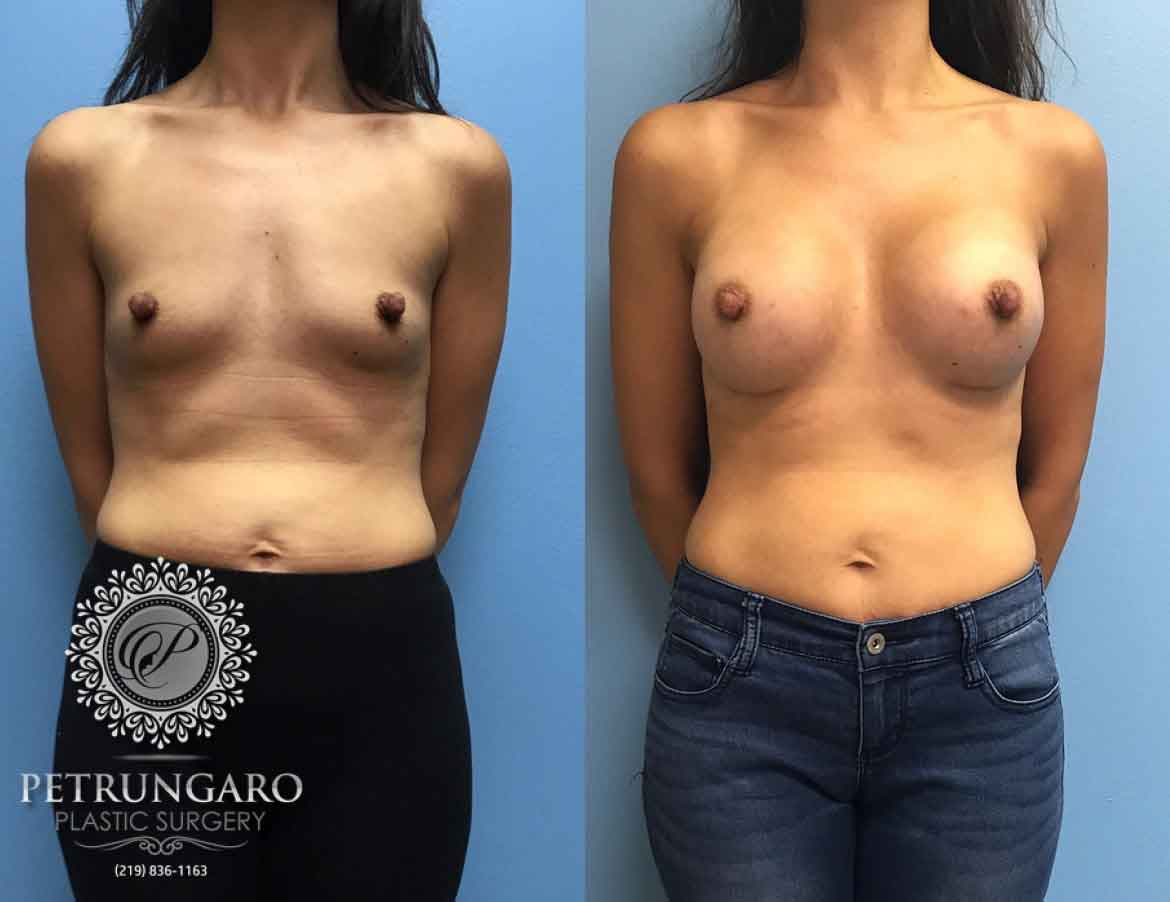 37-breast-augmentation-implants-chicago-5
