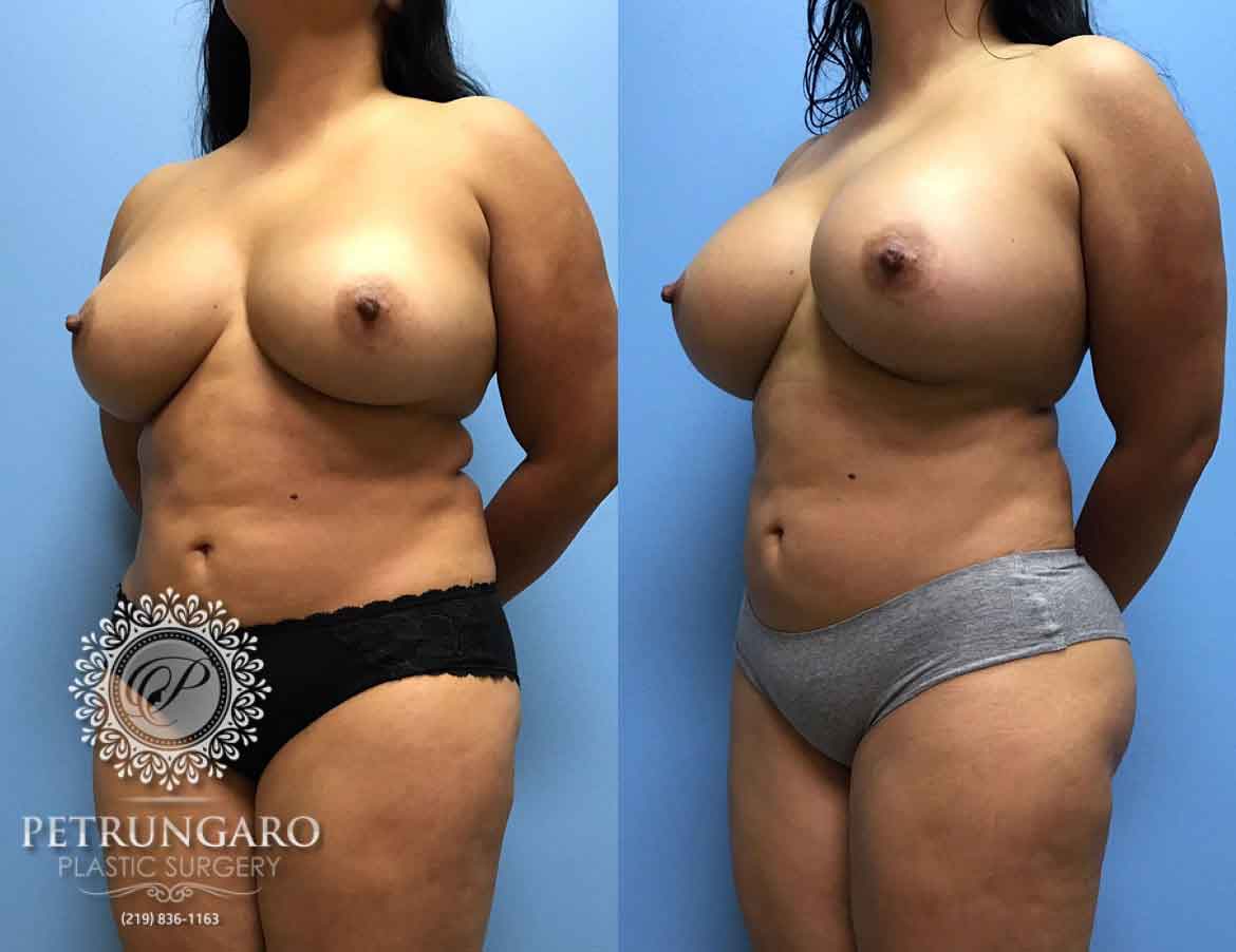 38-breast-augmentation-1