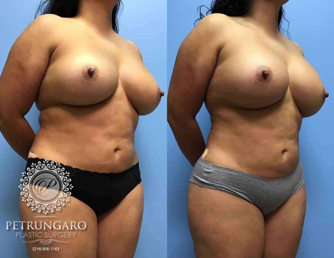 38-breast-augmentation-2