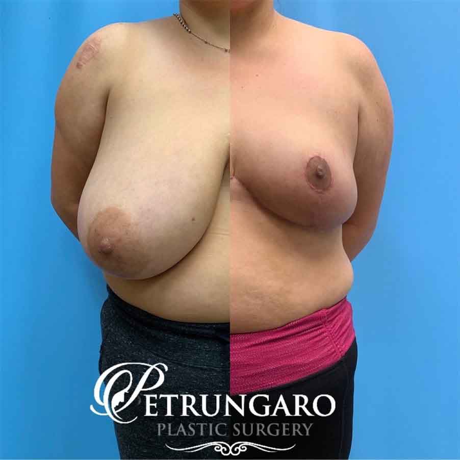 40-before-after-photo-breast-reduction-6