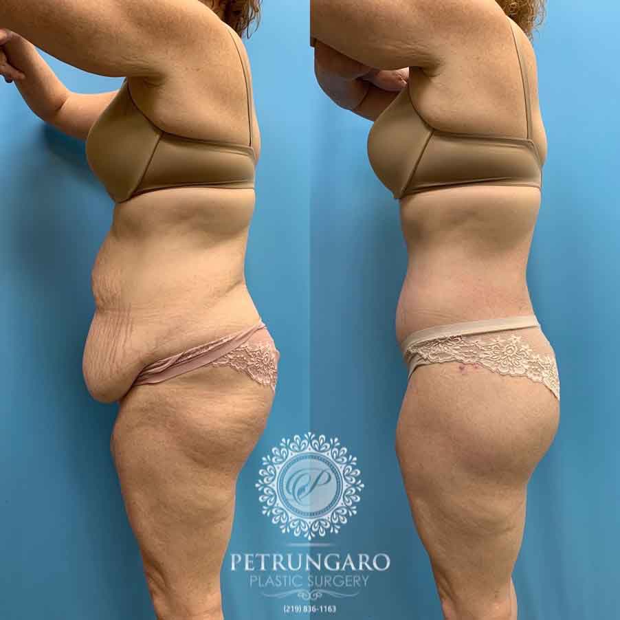 41-before-after-photo-bodylift-1