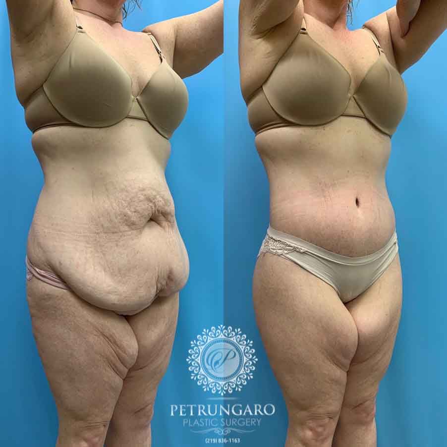 41-before-after-photo-bodylift-5