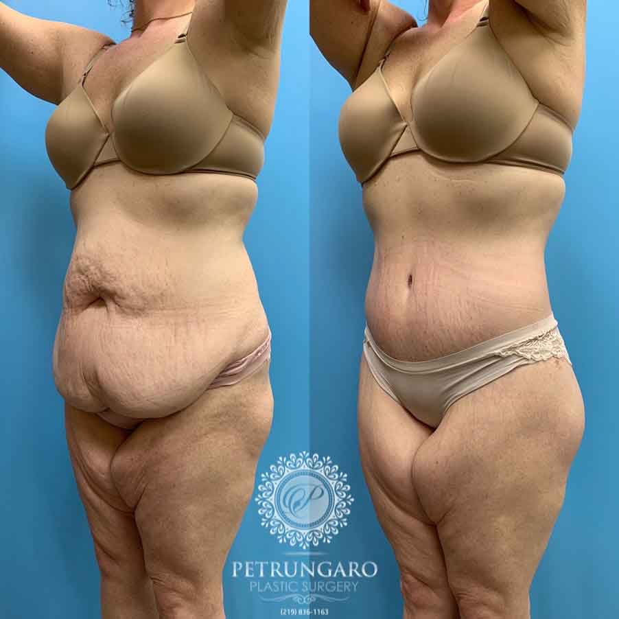 41-before-after-photo-bodylift-6