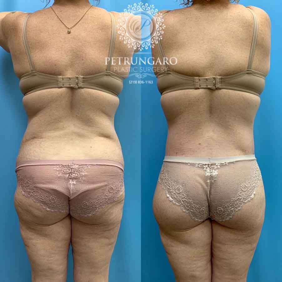 41-before-after-photo-bodylift-7
