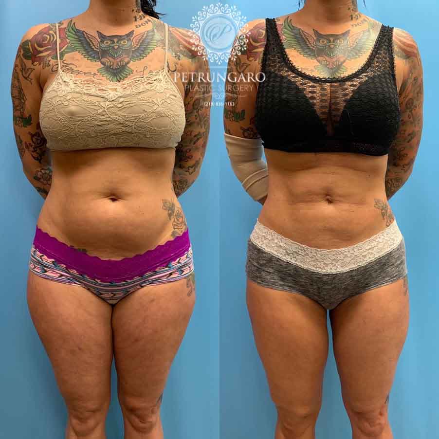 42-before-after-photo-lipo-360-1