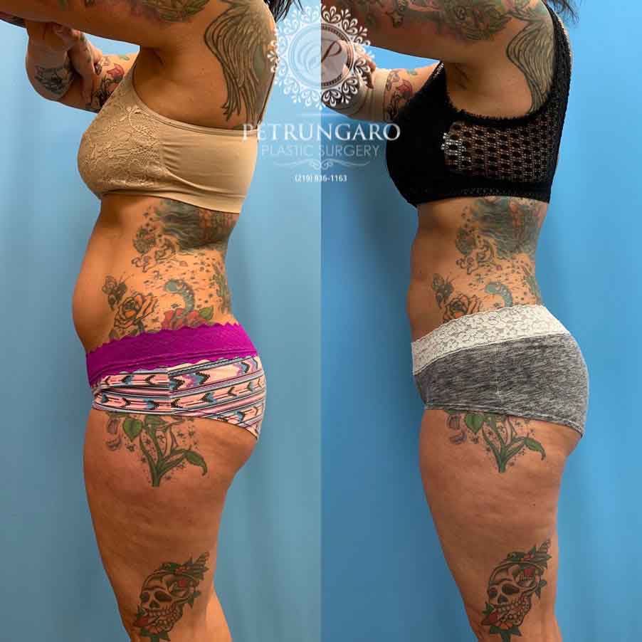 42-before-after-photo-lipo-360-4