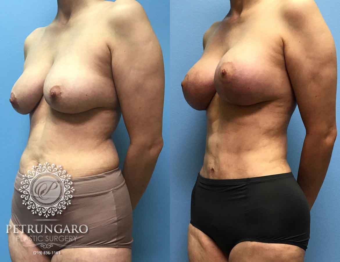 42-breast-lift-augmentation-1