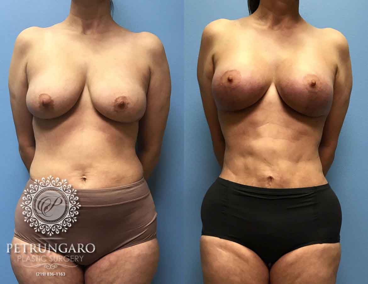 42-breast-lift-augmentation-5