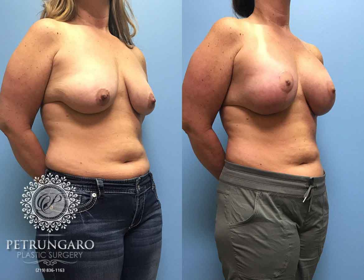 42 F After Breast Lift Augmentation | Petrungaro Plastic Surgery