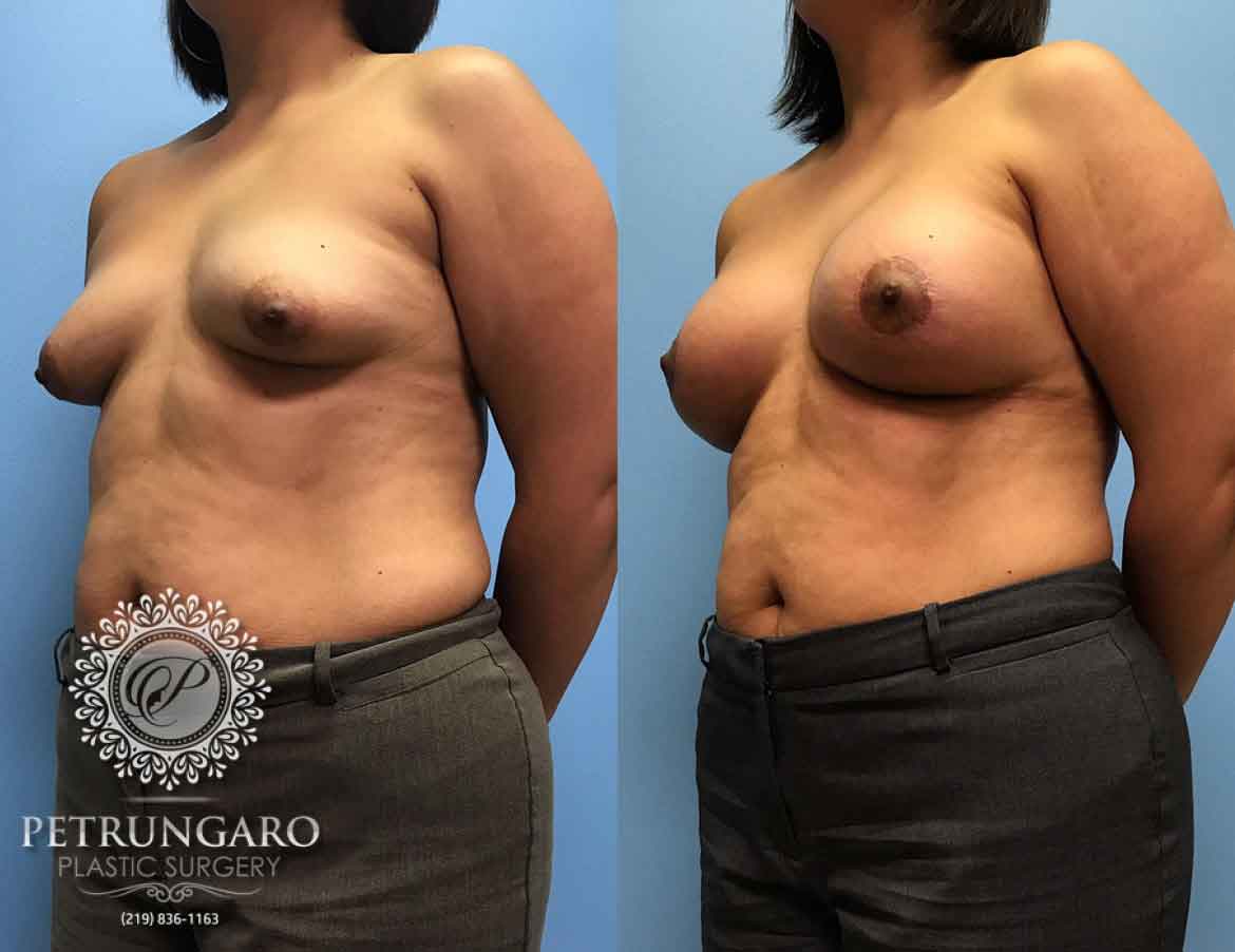 42-breast-lift-aumentation-2