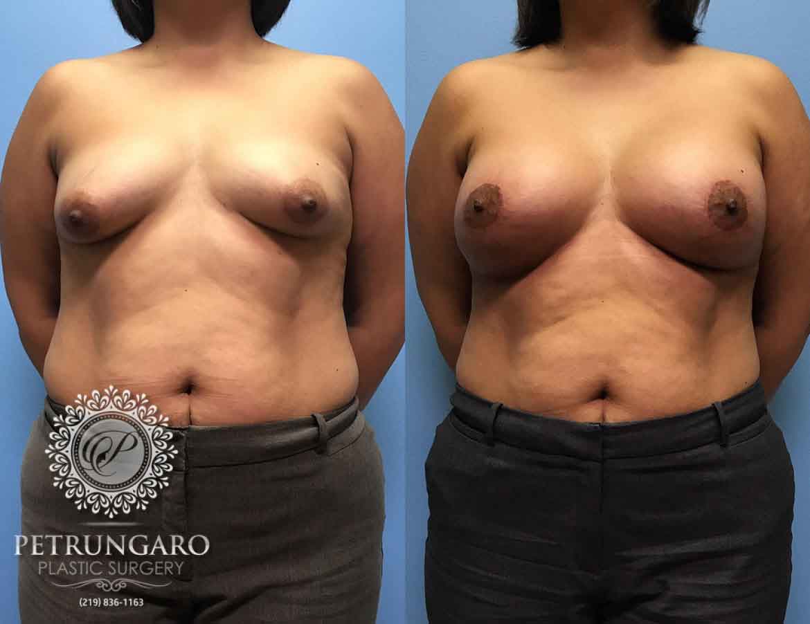 42-breast-lift-aumentation-5