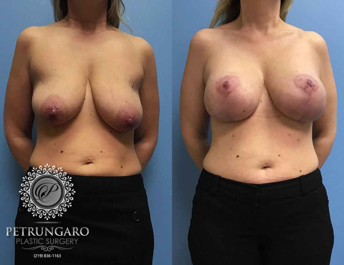 43-breast-lift-with-implants-1