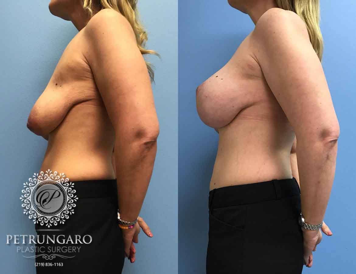 43-breast-lift-with-implants-3