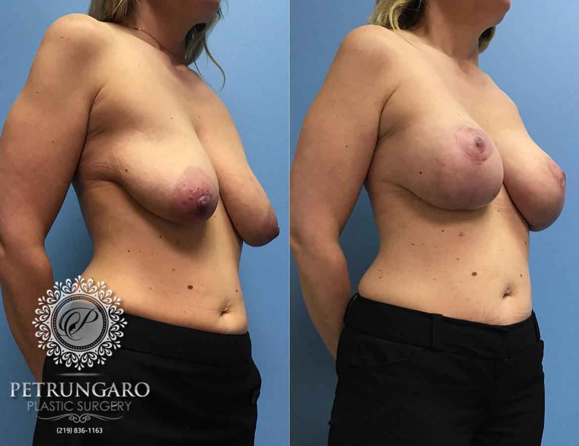 43-breast-lift-with-implants-4