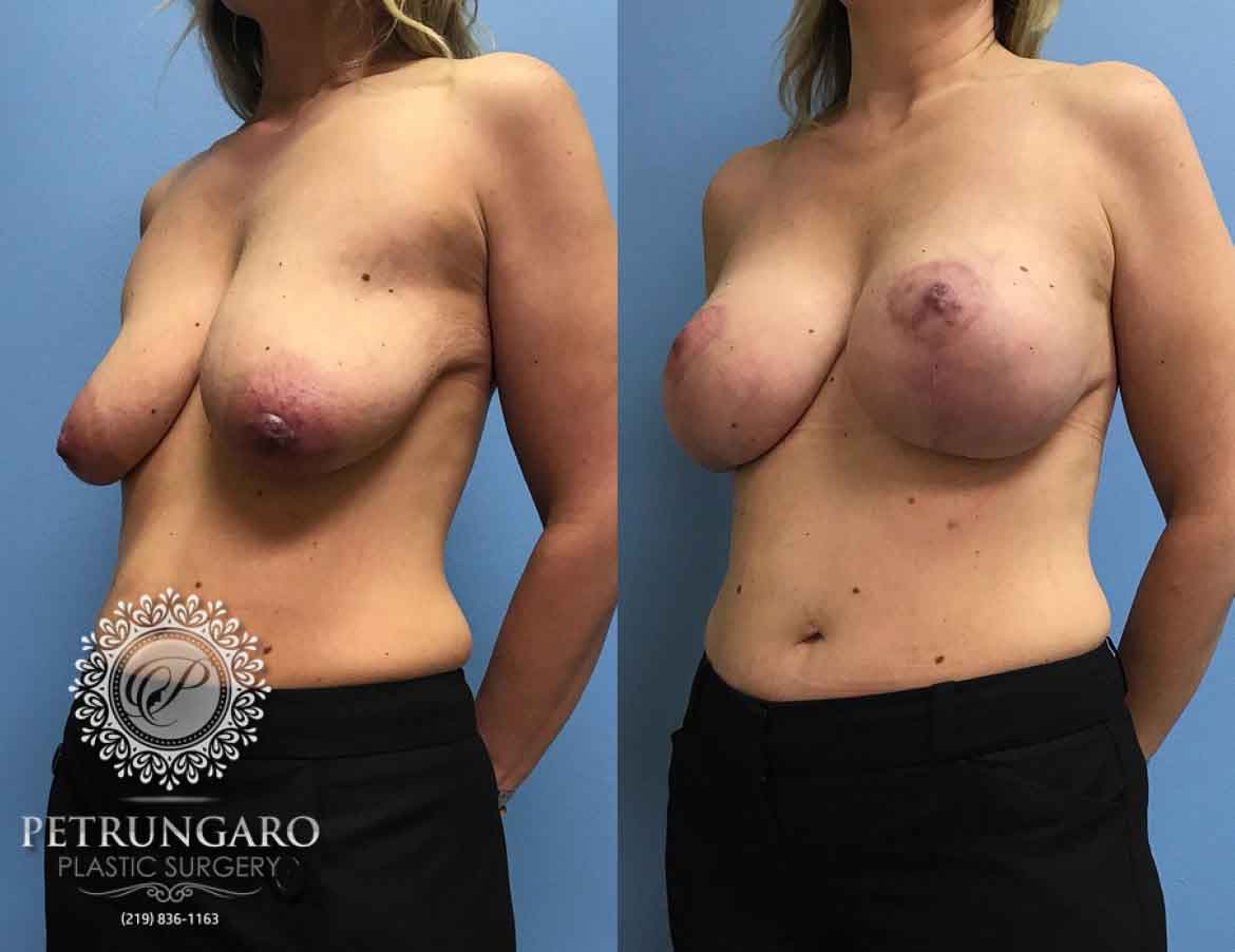 43-breast-lift-with-implants-5