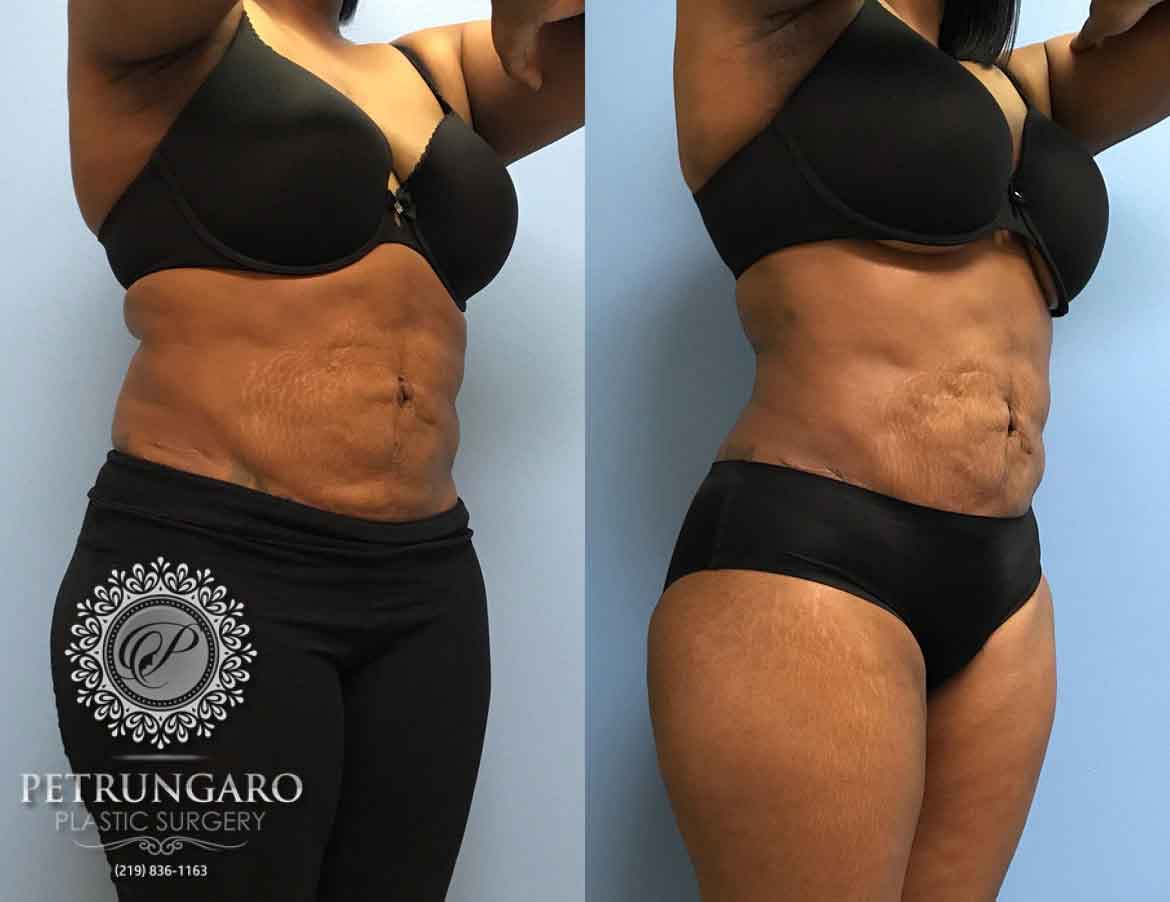 Abdomen and Waist Liposuction - Before and After Photos, flanks