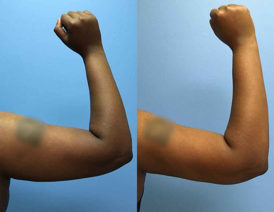 43-year-old-woman-3-months-after-liposuction-posterior-upper-arms-1-1