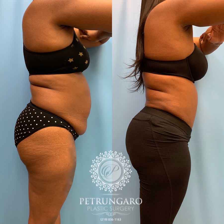 44-before-after-photo-tummy-tuck-liposuction-3