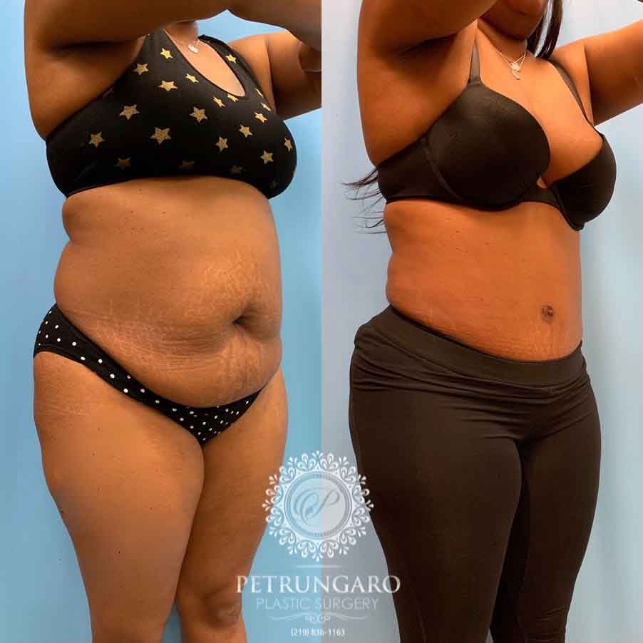 44-before-after-photo-tummy-tuck-liposuction-4
