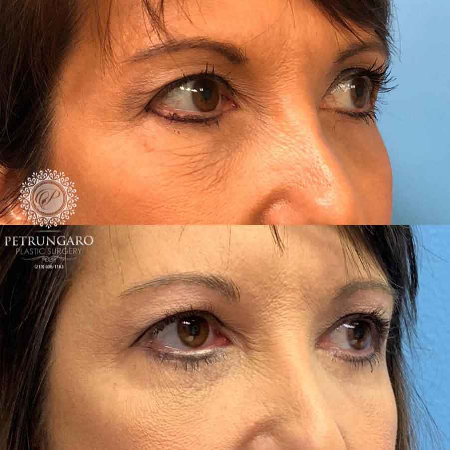 47-woman-before-after-eyelid-surgery-3