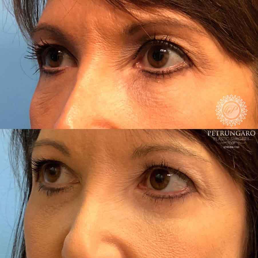 47-woman-before-after-eyelid-surgery-4