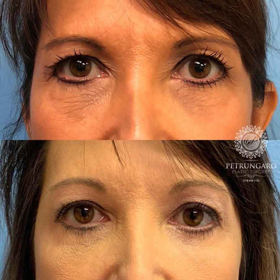 47-woman-before-after-eyelid-surgery-5