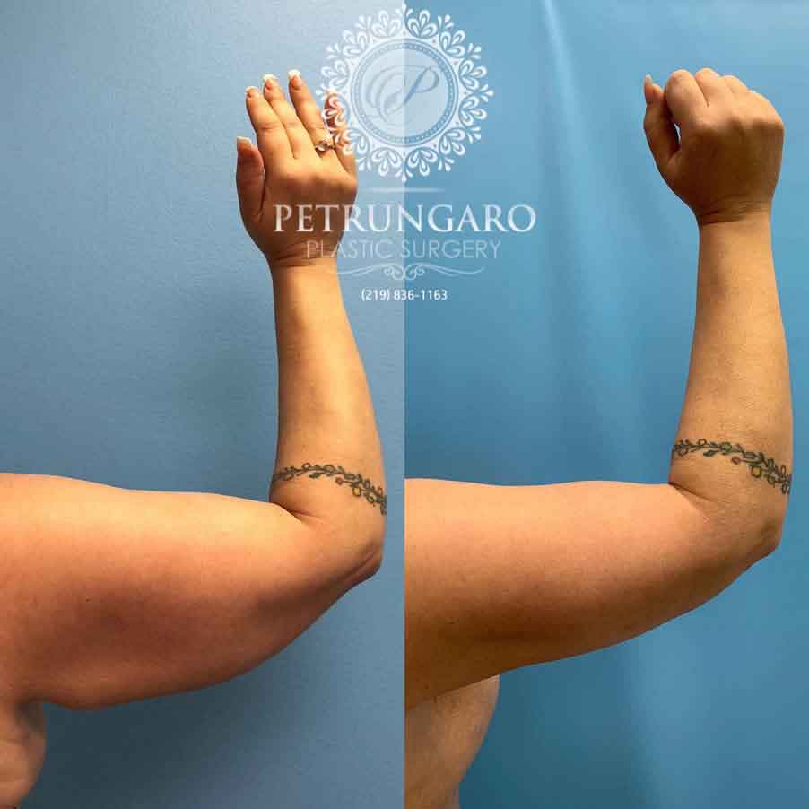 48-before-after-arm-lift-liposuction-1