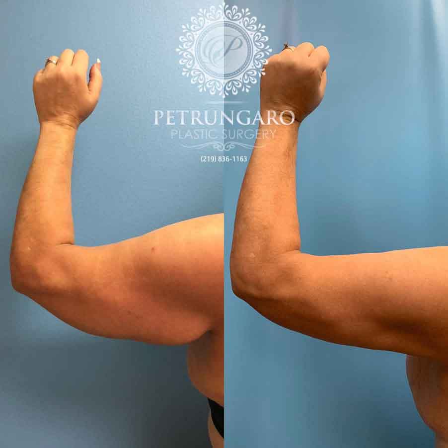 48-before-after-arm-lift-liposuction-2