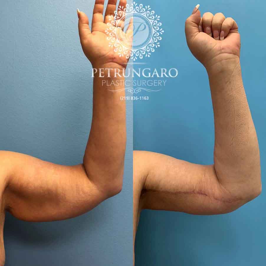 48-before-after-arm-lift-liposuction-3
