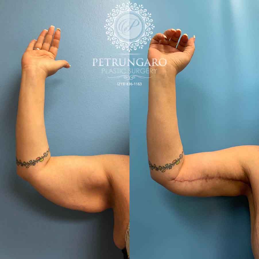 48-before-after-arm-lift-liposuction-4
