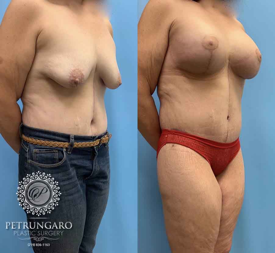 50-before-after-breast-lift-implants-1