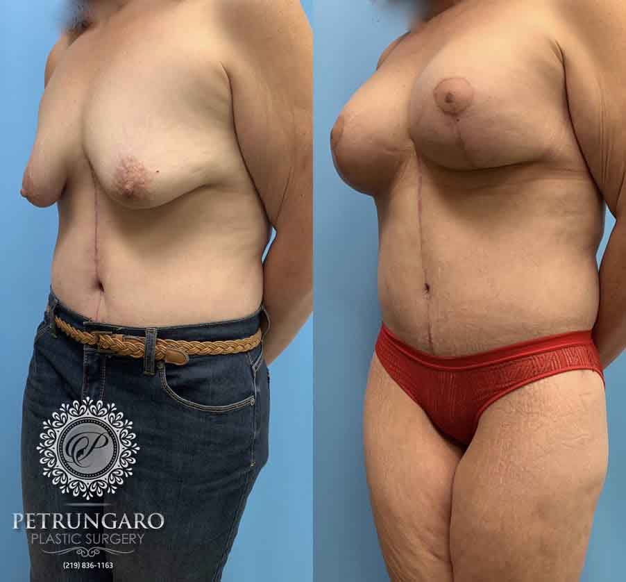 50-before-after-breast-lift-implants-2