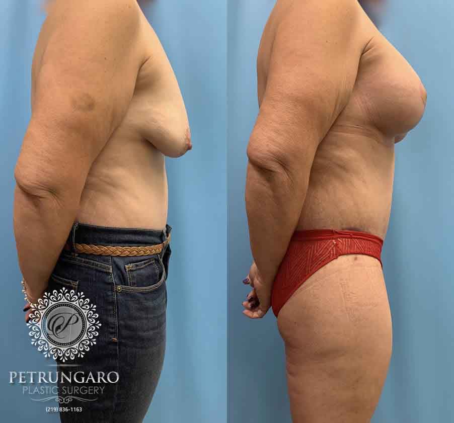 50-before-after-breast-lift-implants-3