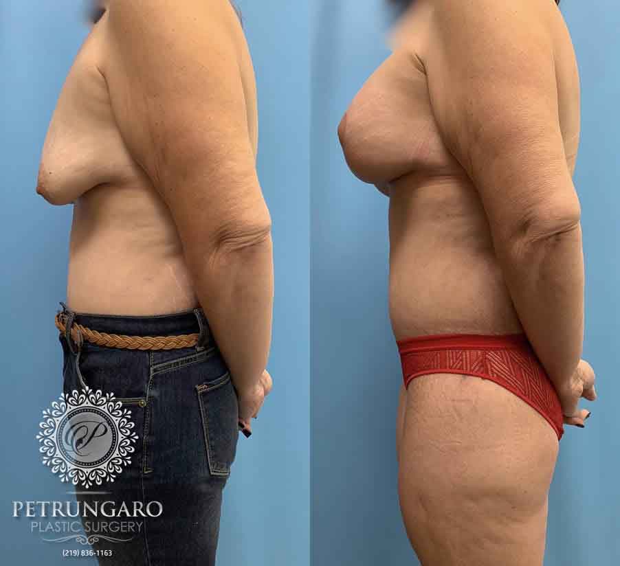50-before-after-breast-lift-implants-4