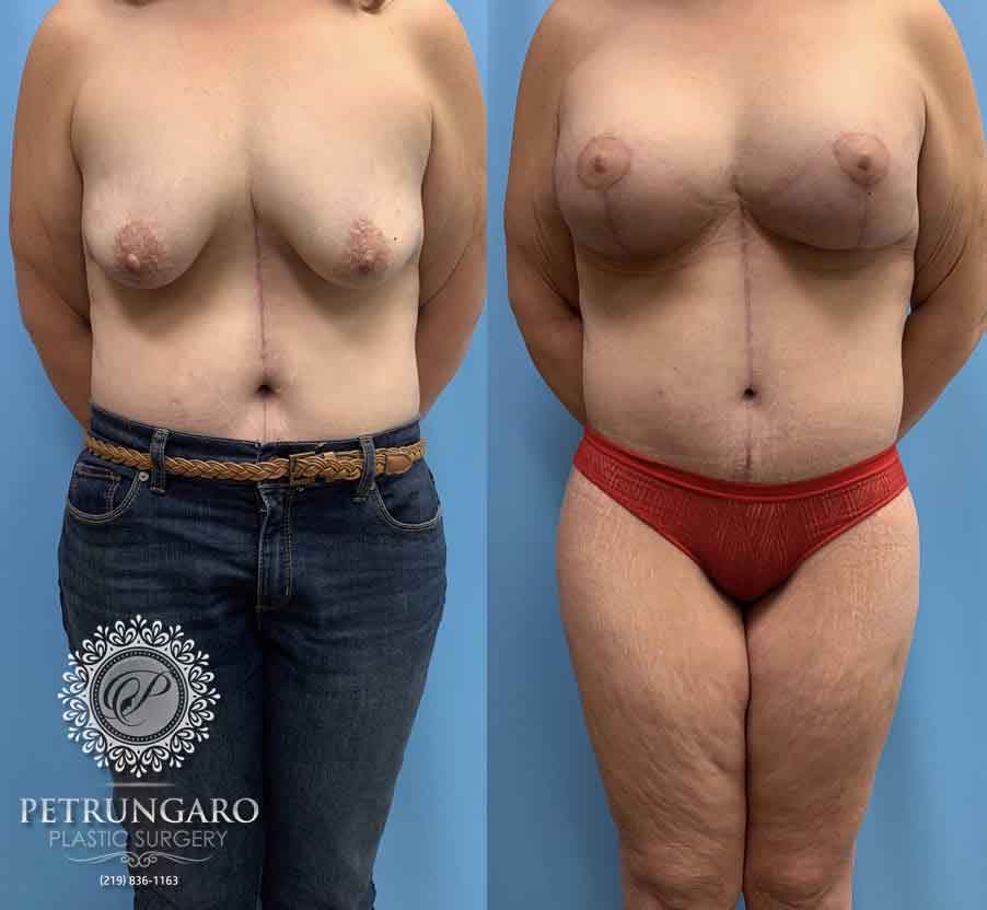50 F After Breast Lift With Implants | Petrungaro Plastic Surgery