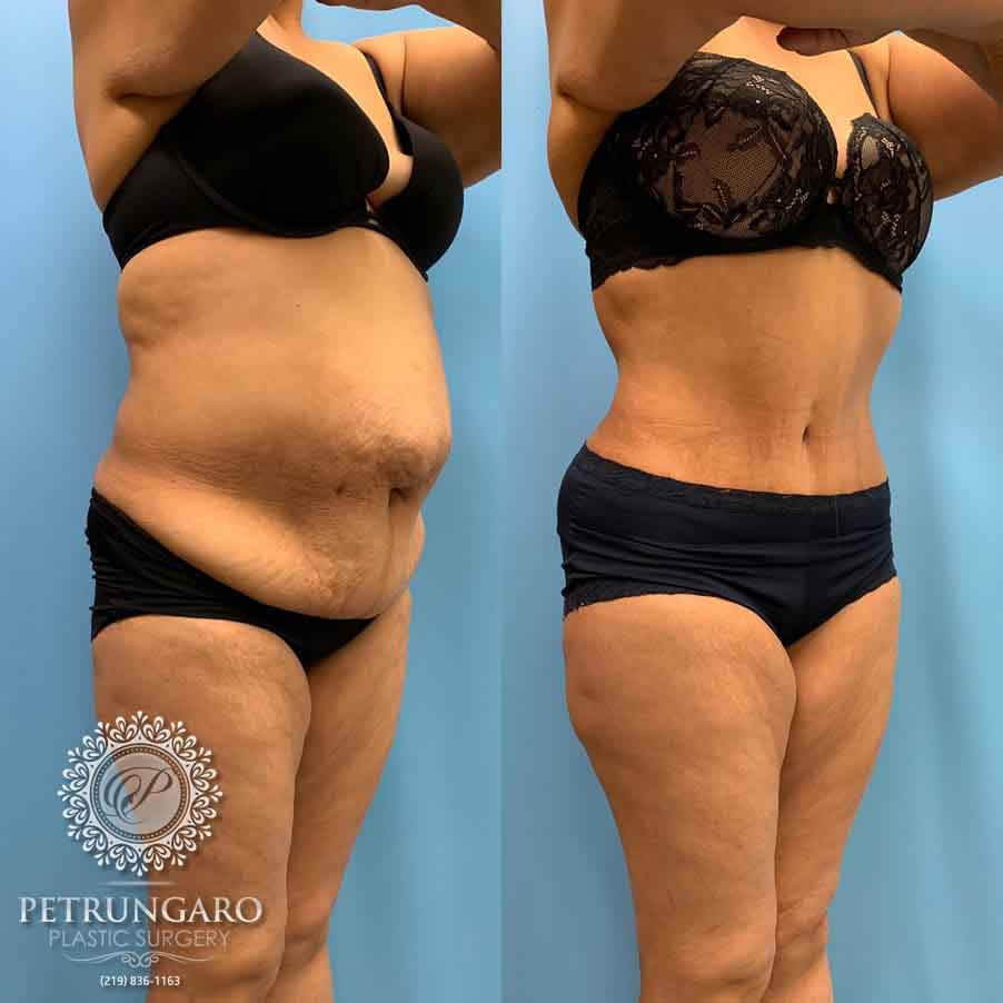 52-before-after-tummy-tuck-lipo-360-3