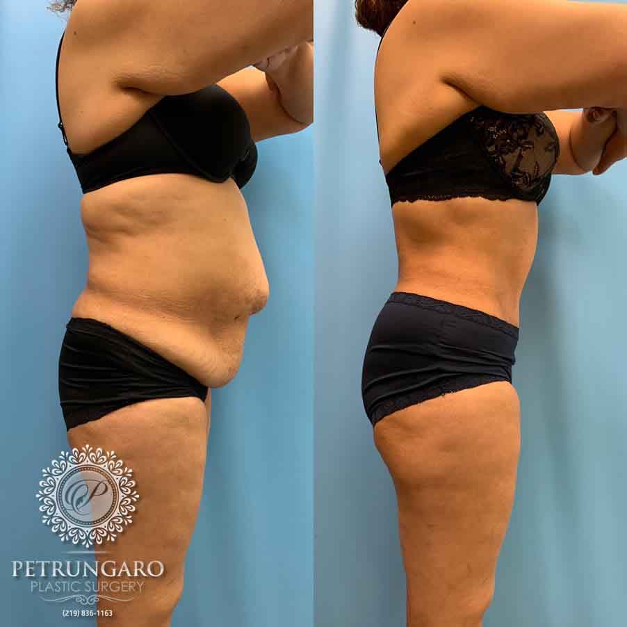 52-before-after-tummy-tuck-lipo-360-4