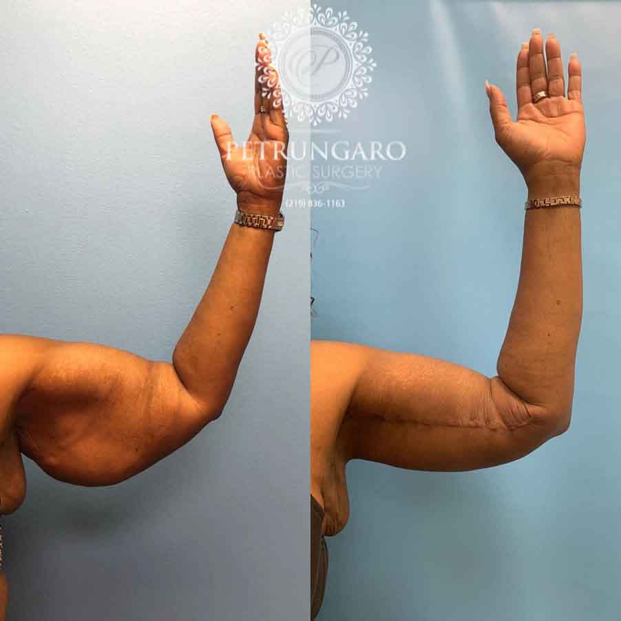 53-before-after-arm-lift-liposuction-3