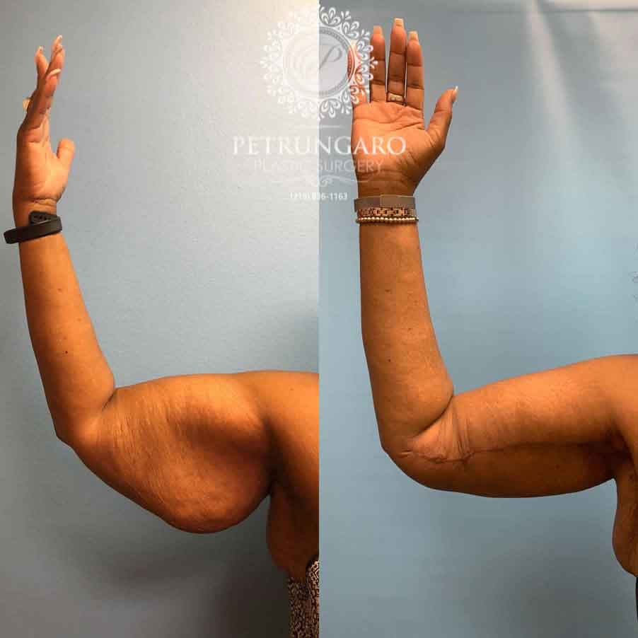 53-before-after-arm-lift-liposuction-4