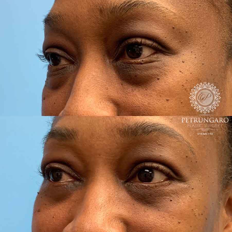 53-before-after-eyelid-lift-2