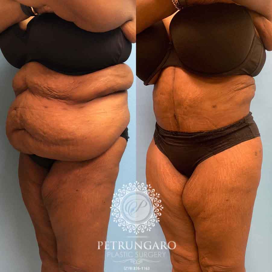 53-before-after-fleur-de-lis-body-lift-liposuction-brazilian-butt-lift-3